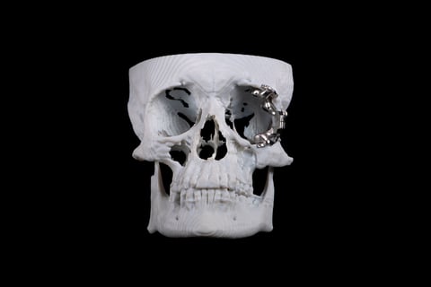 Oral Arts Dental Labs Orbital Implant Case