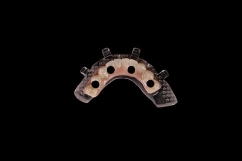 Implant Crown Prosthodontics