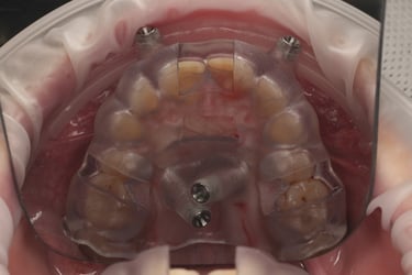 Fixation Screw Guide Incisal Edge View