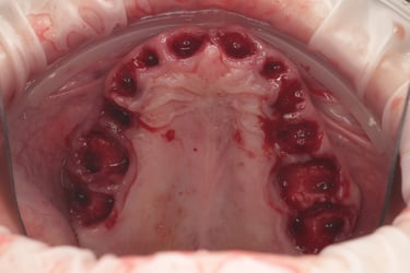 Full Mouth Extraction of Terminal Dentition