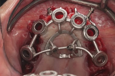 Oral Arts Dental Labs Osteotomy Guide