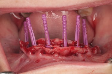 Rotation Verification of Full Arch Implant