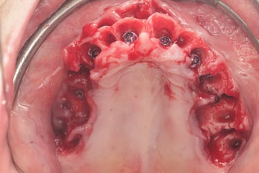 MUA Placement of Maxillary Arch