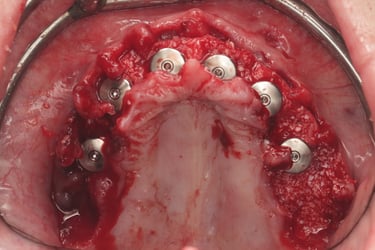 Bone Grafting for All-on-X