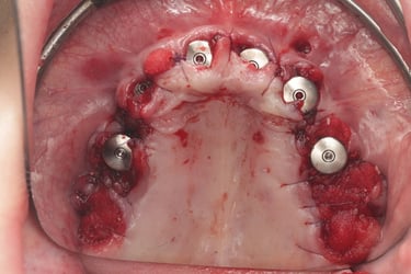 Soft Tissue Closure for Full Arch Case