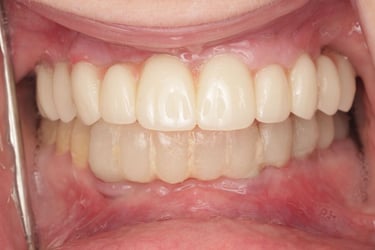 Oral Arts Dental Labs Monolithic Milled Full Arch FP1