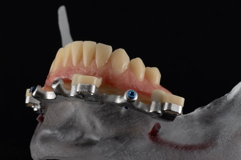 Full Arch on Surgical Guide