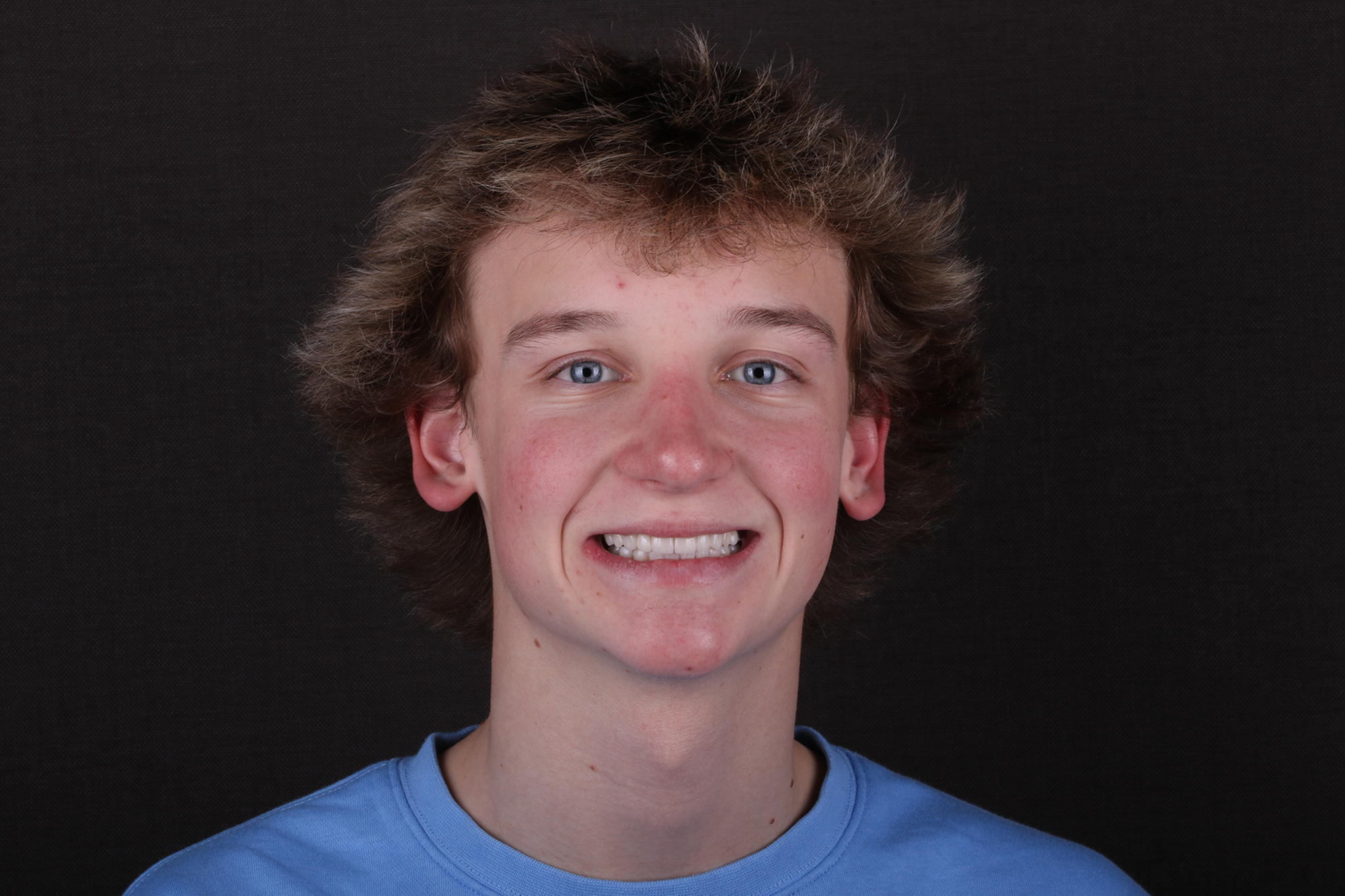 Ultra Z Esthetic Select Crown 5Y-Case2957854-2